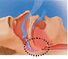 いびきをかく＝気道が狭くなる 